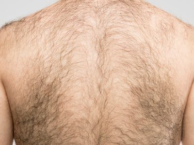 Diode hair and laser removal – Back (Men)