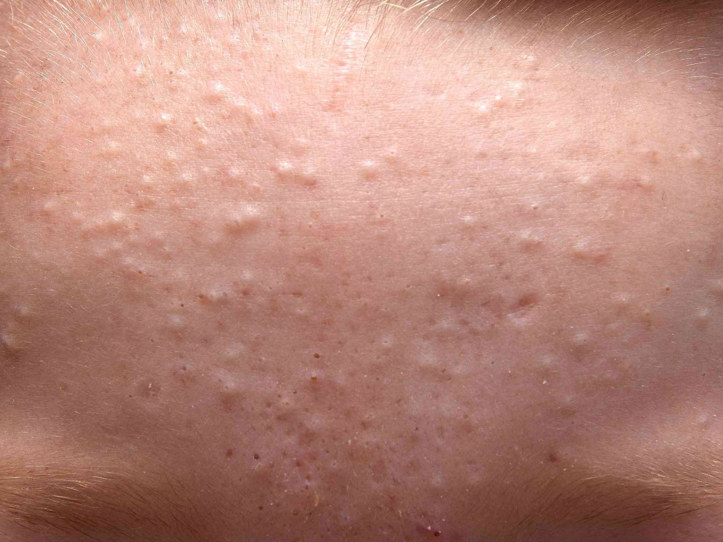 Comedonian Acne