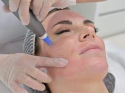 Dermapen Revitalizing Treatment Through