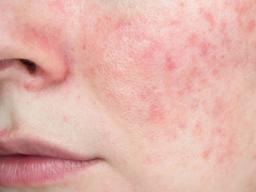 Acne Inflammatory / Rosacea